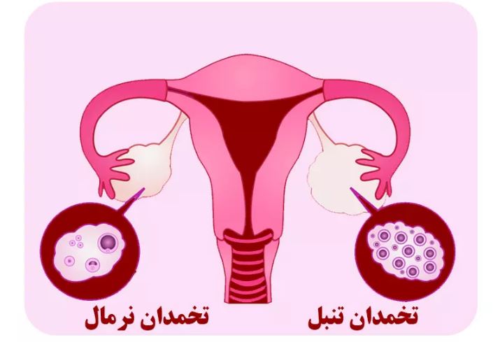 درمان تنبلی تخمدان