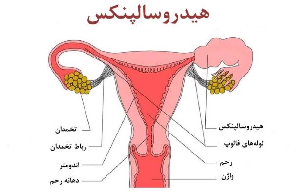 درمان هیدروسالپنکس