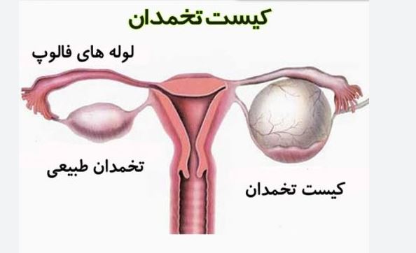 درمان کیست تخمدان و فیبرم